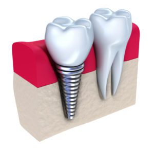 Affordable dental implants in Clearwater Florida