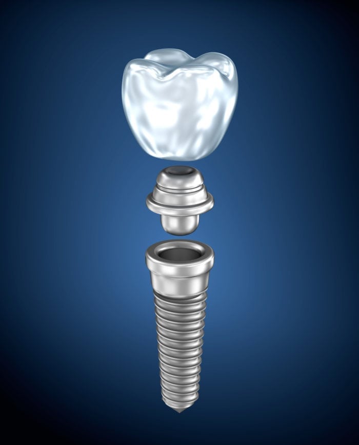 Benefits of Implants Clearwater, Florida dentist