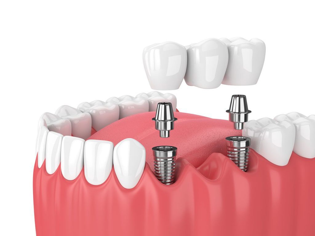 types of dental implants in Clearwater Florida