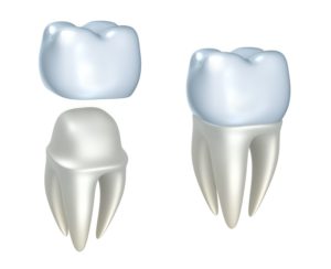 dental crown procedure in Clearwater Florida