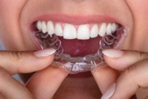 translucent and beautiful Invisalign teeth straightening treatment