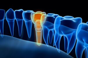 aftercare for dental implants