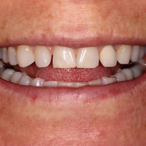 before dental treatment in Clearwater, FL by Dr. Natasha Radosavljevic, DDS