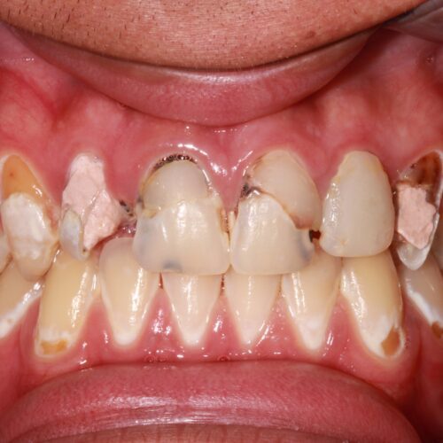 before dental treatment in Clearwater, FL by Dr. Natasha Radosavljevic, DDS