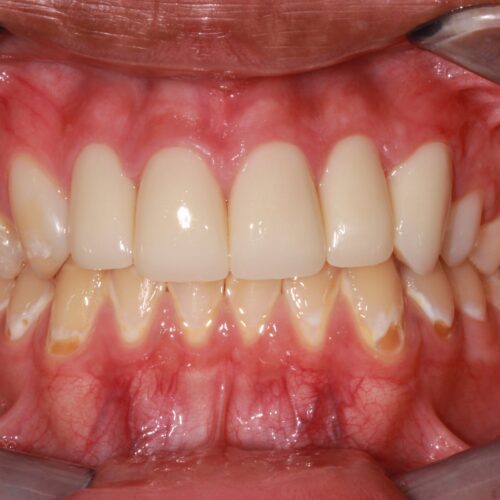 after dental treatment in Clearwater, FL by Dr. Natasha Radosavljevic, DDS
