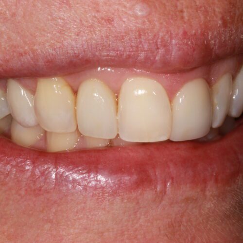after dental treatment in Clearwater, FL by Dr. Natasha Radosavljevic, DDS