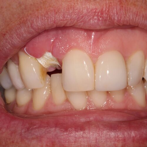 before dental treatment in Clearwater, FL by Dr. Natasha Radosavljevic, DDS