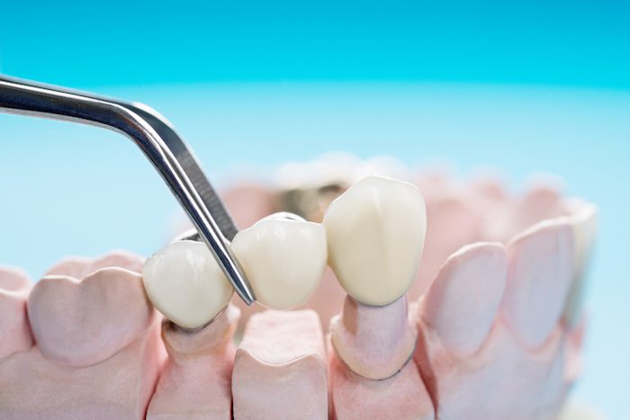 dental bridges in clearwater, florida