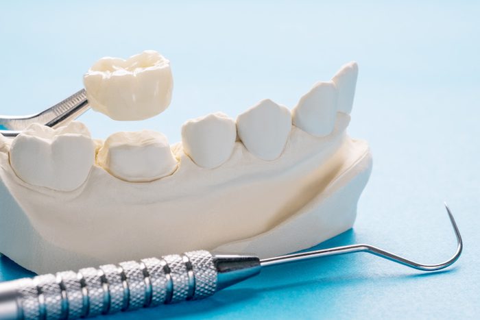 dental crown treatment in clearwater, florida