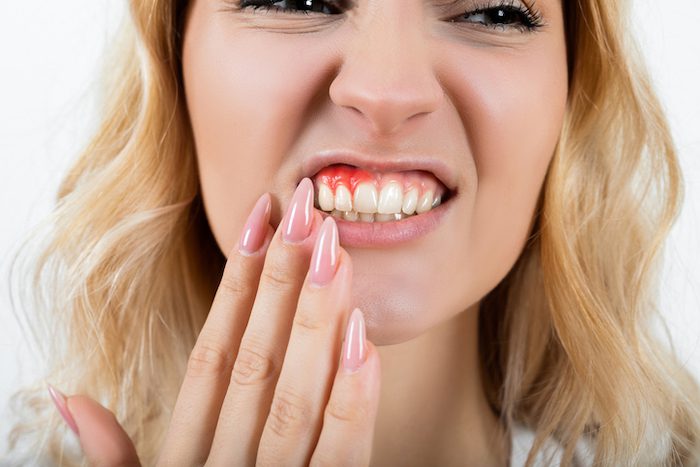 treating bleeding gums in clearwater, florida