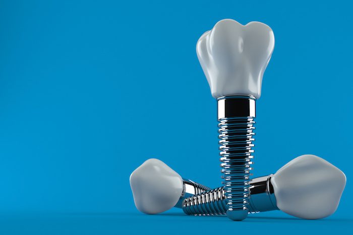 dental implant treatment in clearwater, florida