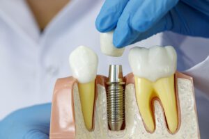 Missing teeth can have several negative impacts, from health complications to aesthetic concerns as well as bite misalignment.