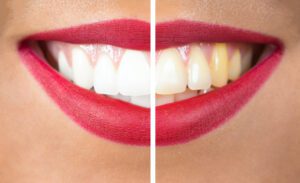 Professional teeth whitening offers a superior solution that addresses various limitations of store-bought options.