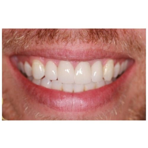 after dental treatment in Clearwater, FL by Dr. Natasha Radosavljevic, DDS