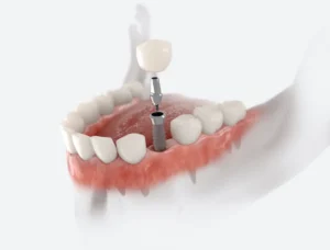 Dental Implants: The Closest to Your Natural Tooth in Clearwater, FL